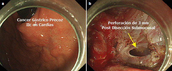 Perforación de Estómago