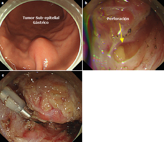 Perforación de Estómago