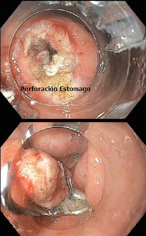 Perforación de Estómago