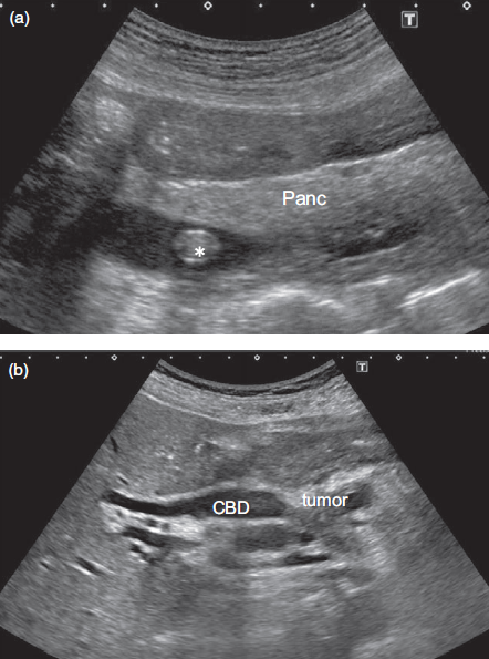 Hallazgos ultrasonográficos en Colangitis Aguda