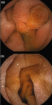 Ampolla de Vater (a) e Intestino Delgado Normal (b)