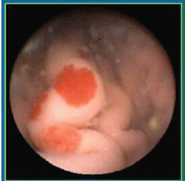 Angioectasia (2)