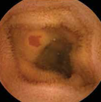 Angiectasia