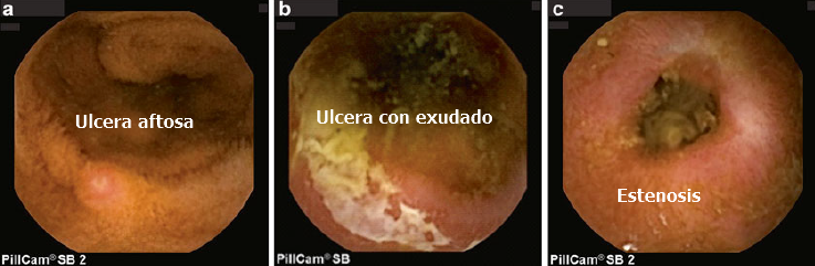 Hallazgos de cápsula endoscópica en enfermedad inflamatoria