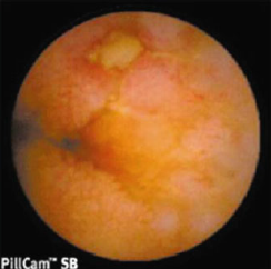 Úlcera en Intestino Delgado