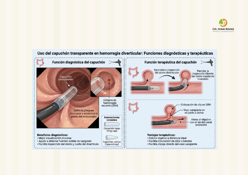 Capuchon para hemorragia diverticular