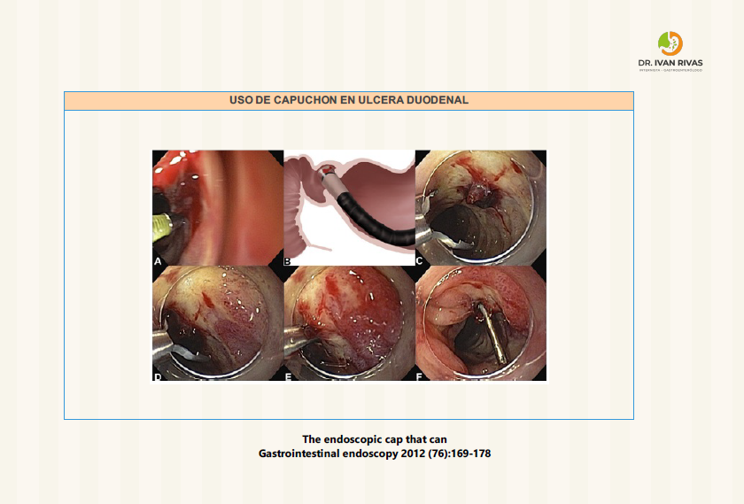 Uso de capuchón en úlcera duodenal