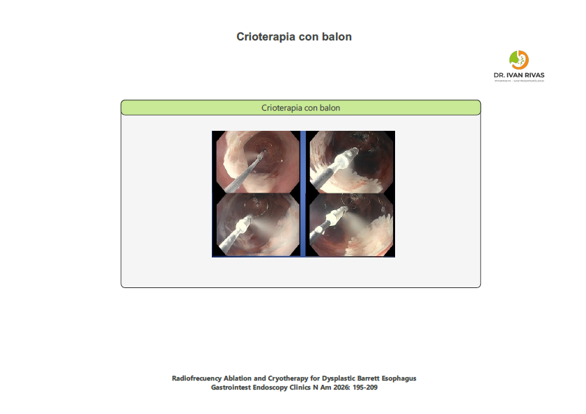 Crioterapia con balón