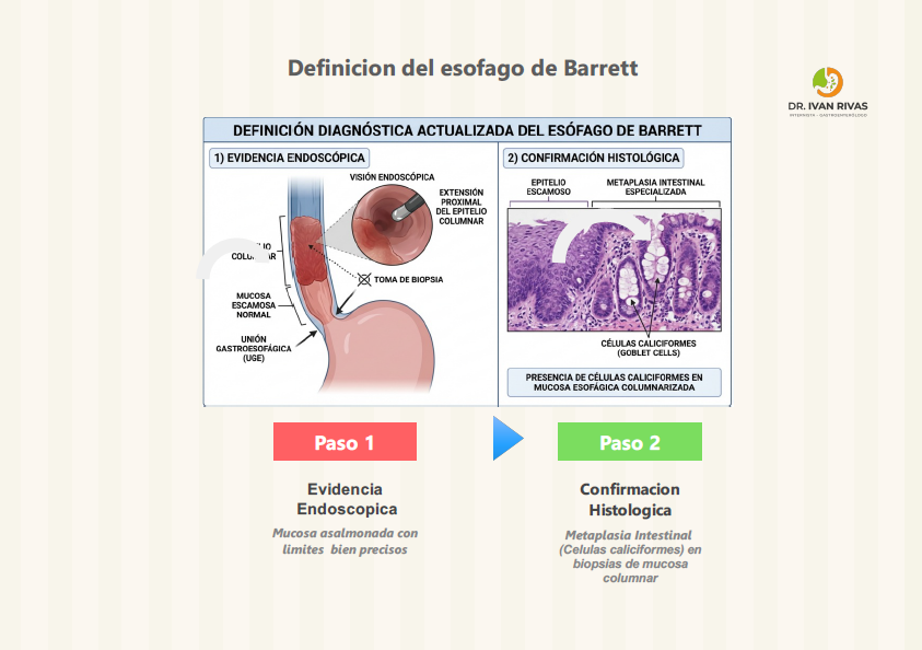 Definicion de Esofago de Barrett