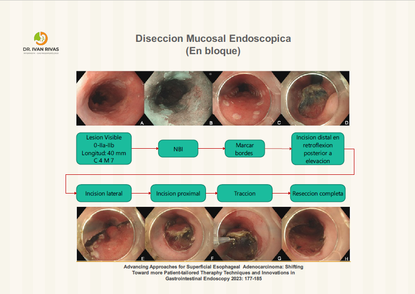 Disección mucosal endoscópica