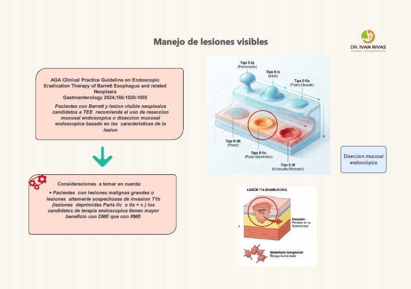 Resección Mucosal Endoscópica Vs Diseccion mucosal endoscopica en esofago de Barrett