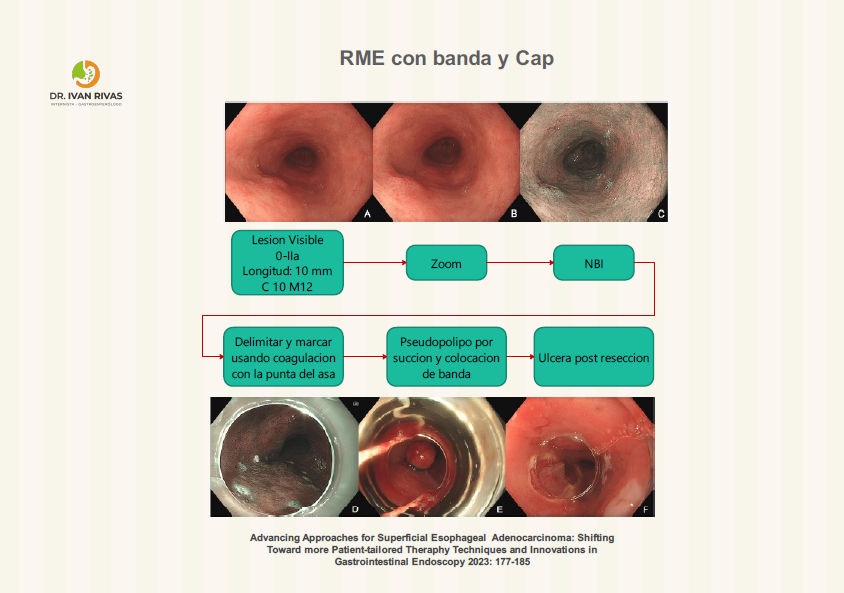 Resección mucosal endoscópica con cap y banda