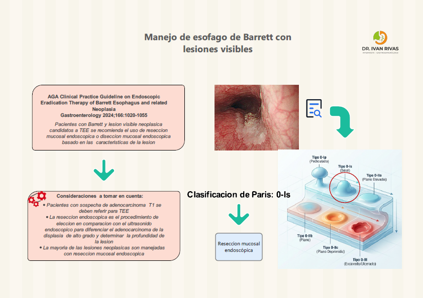 Resección mucosal endoscopica en Esofago de Barrett