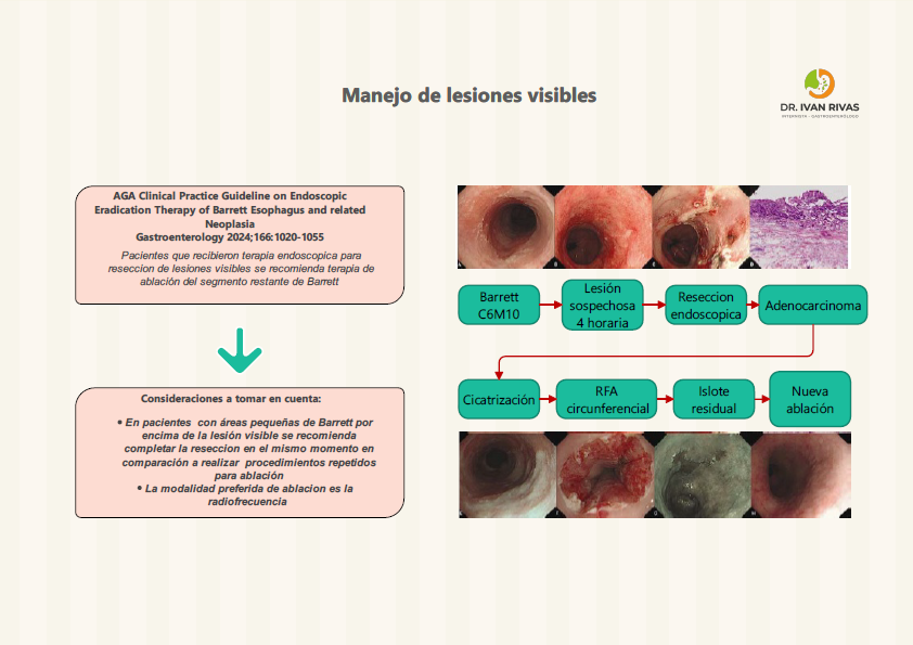 Terapia de Ablación con Radiofrecuencia