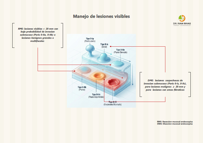 Lesiones visibles en Esofago de Barrett