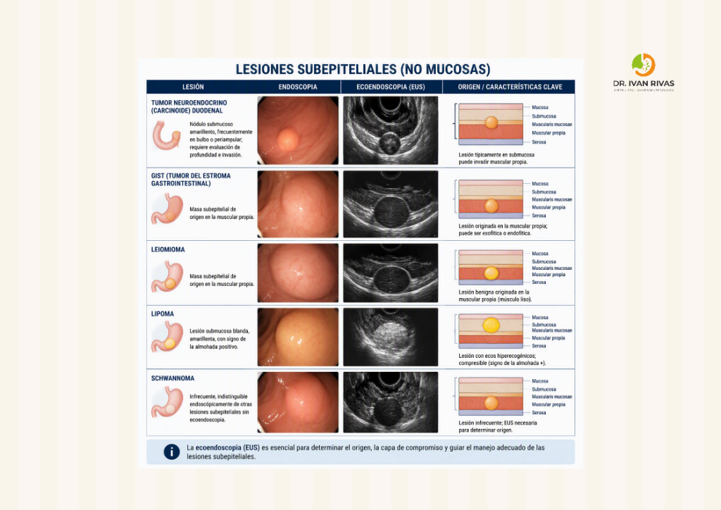 Lesiones subepiteliales duodenales