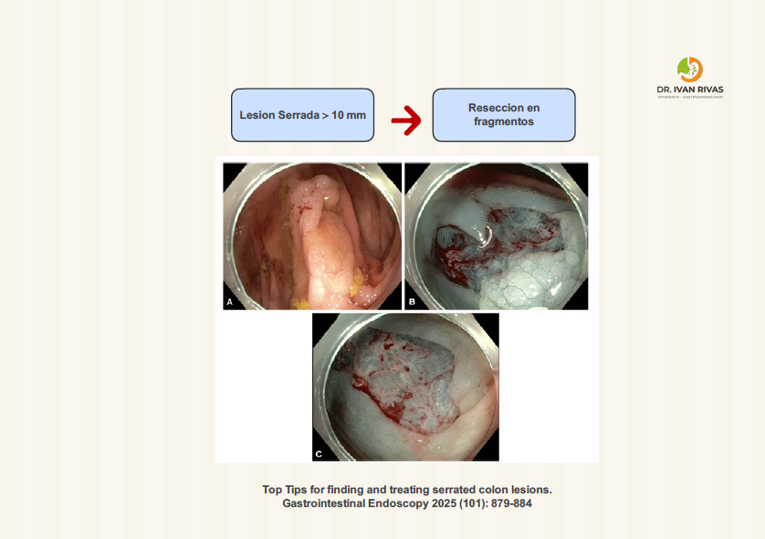 Reseccion de lesion mayor a 10 mm