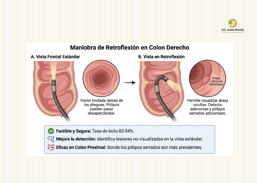 Retroflexión en Ciego