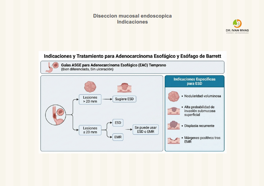 Indicaciones de la diseccion mucosal endoscópica en esofago