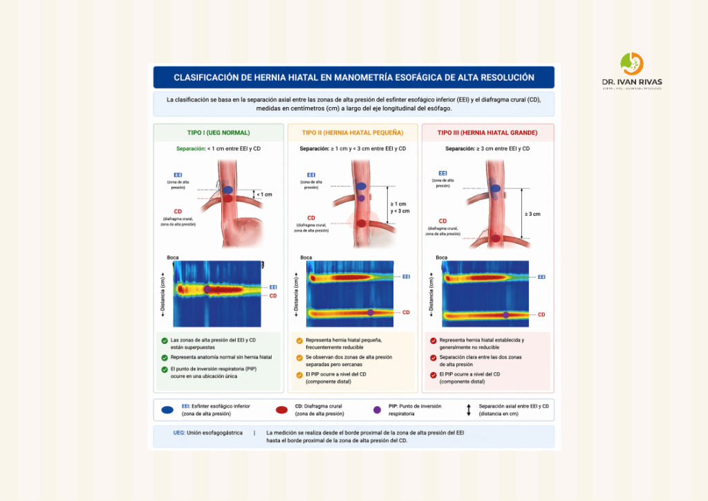 Clasificación de la hernia hiatal por manometría esofágica de alta resolución