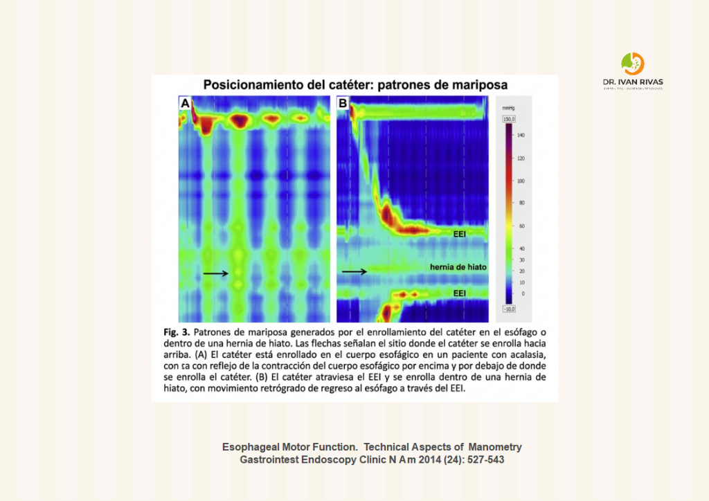 Posicionamiento del catéter en manometria esofagica