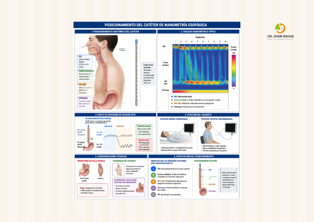 Posicionamiento del catéter en manometría esofágica de alta resolución