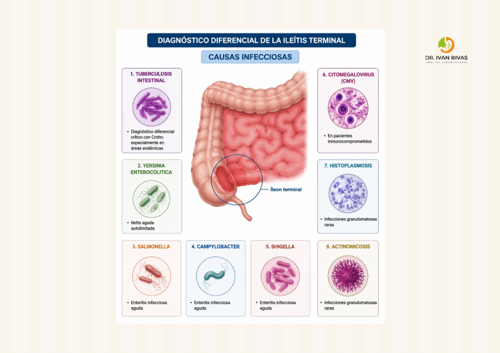 Diagnóstico diferencial de la ileítis terminal