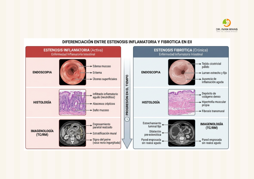 Diferencia entre estenosis inflamatoria y estenosis fibrótica
