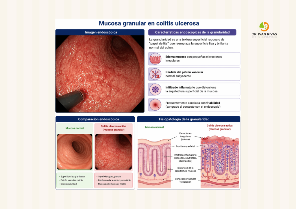 Granularidad en colitis ulcerosa