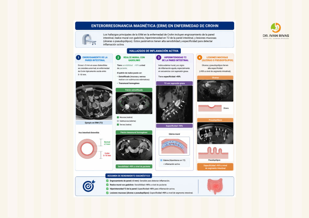 Hallazgos de la enfermedad de Crohn por enterorresonancia