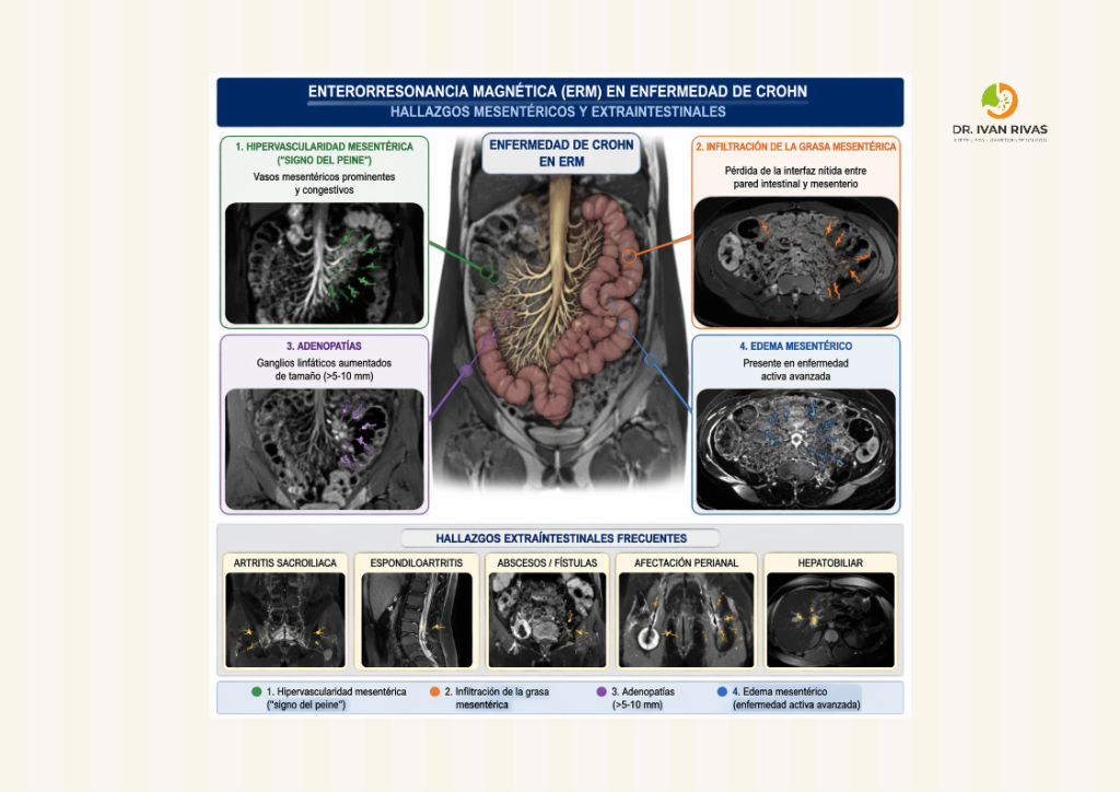 Hallazgos de la enfermedad de Crohn por enterorresonancia