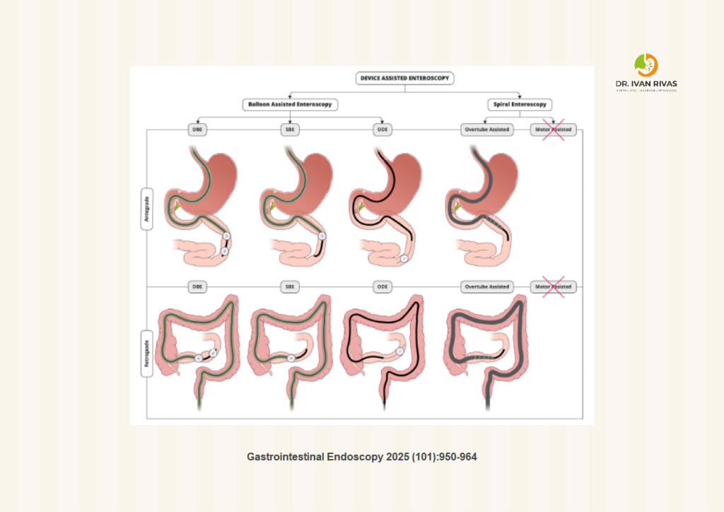 Tipos de enteroscopia