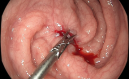 Perforación