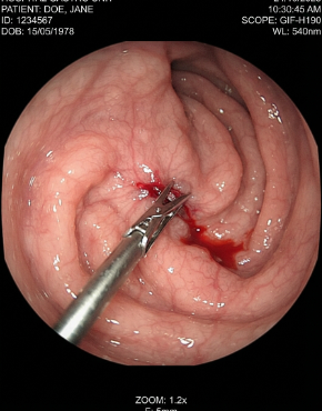 Perforación