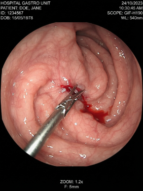Perforación
