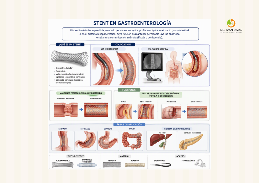 Concepto de stent