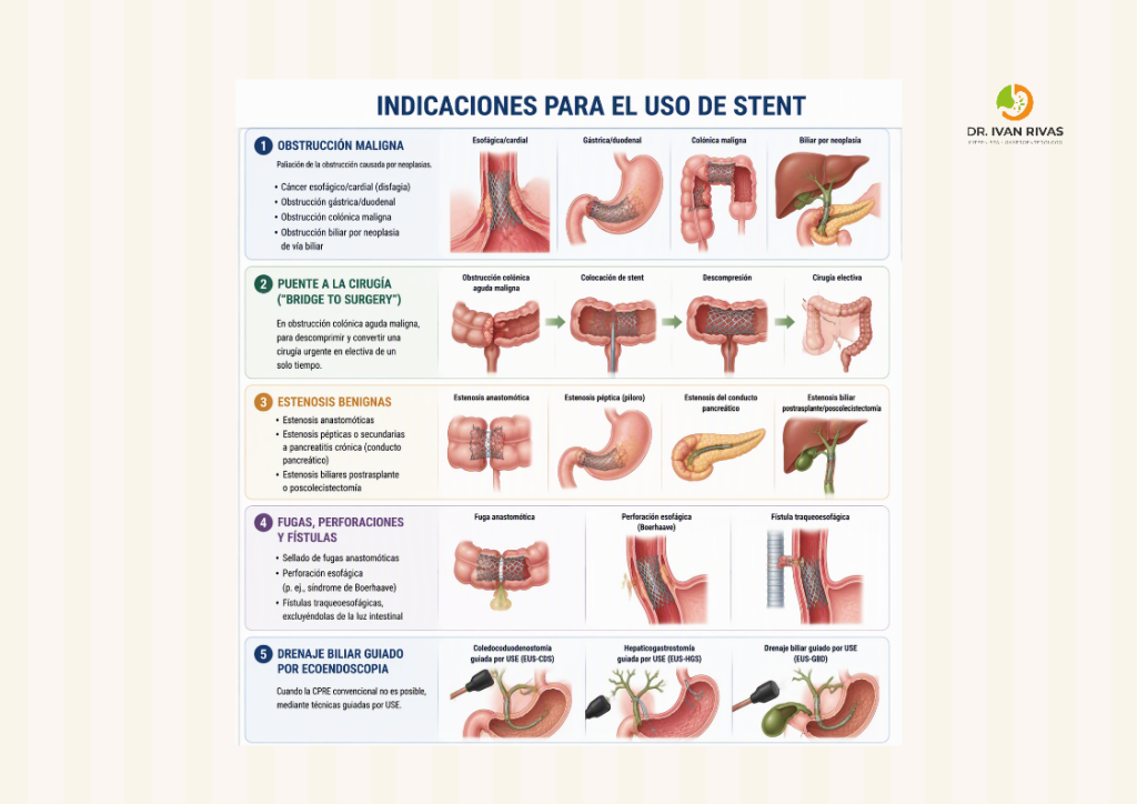Indicaciones para el uso de stents